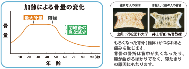 骨粗しょう症