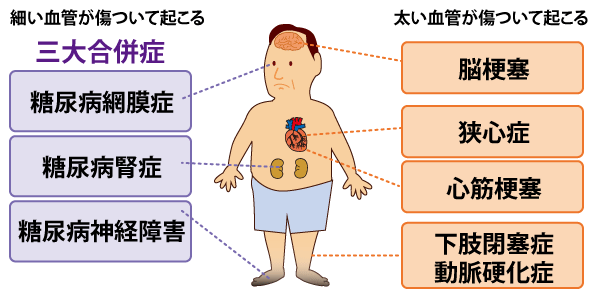 糖尿病の合併症